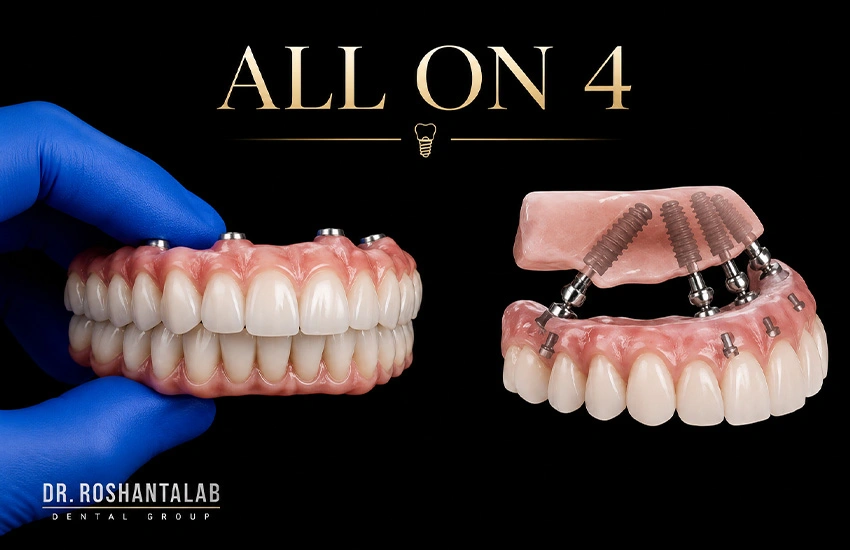 ایمپلنت ثابت کل فک با 4 پایه All on 4