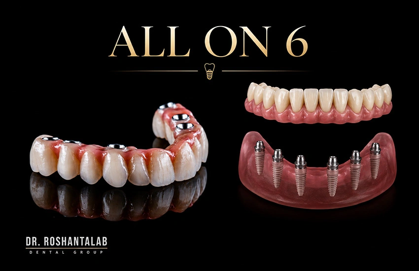 Fixed Full-Arch Implant Prosthesis ایمپلنت ثابت کل فک 6 پایه