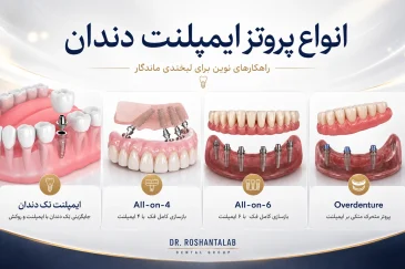 پروتز ایمپلنت دندان در 7 مرحله؛ انواع، ساخت و نصب