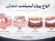 پروتز ایمپلنت دندان در 7 مرحله؛ انواع، ساخت و نصب
