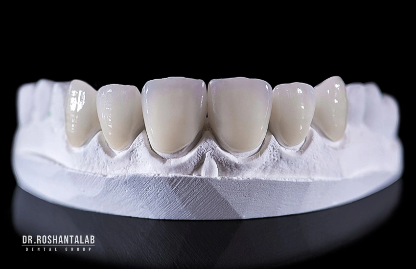 اصلاح طرح لبخند : روکش دندان، لمینت سرامیکی و کامپوزیت ونیر