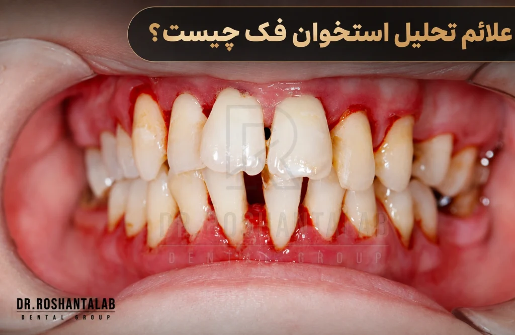 علائم تحلیل استخوان فک چیست؟