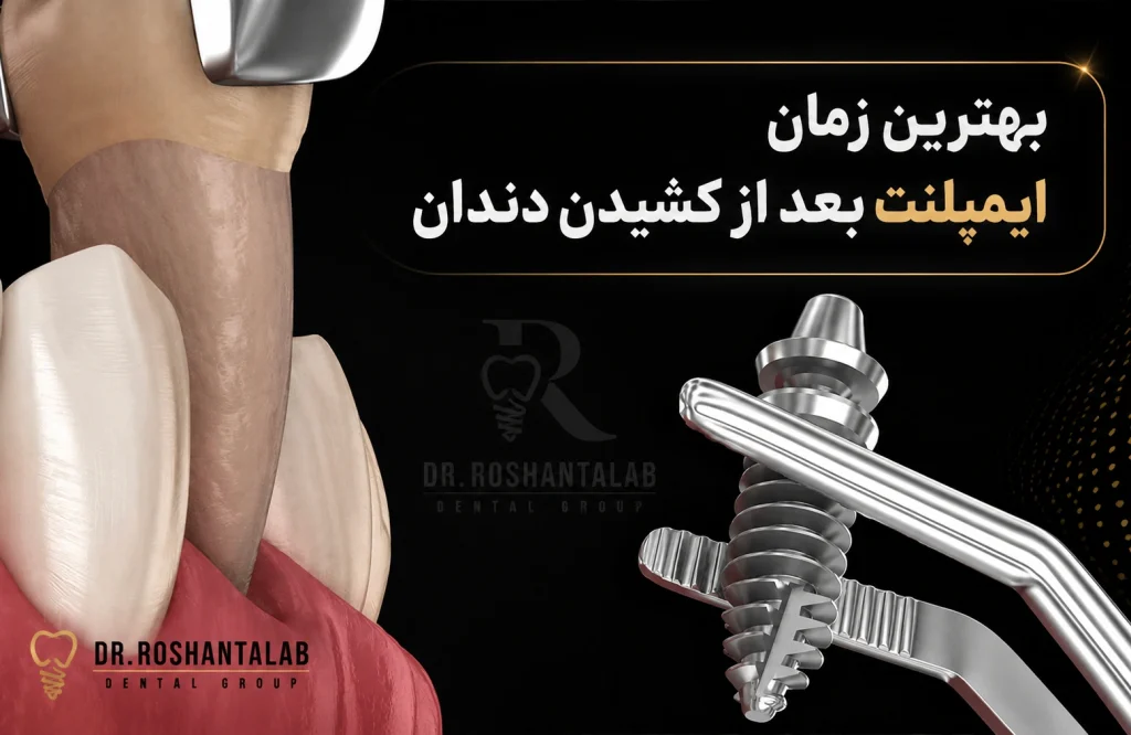 راهنمای بهترین زمان ایمپلنت بعد از کشیدن دندان