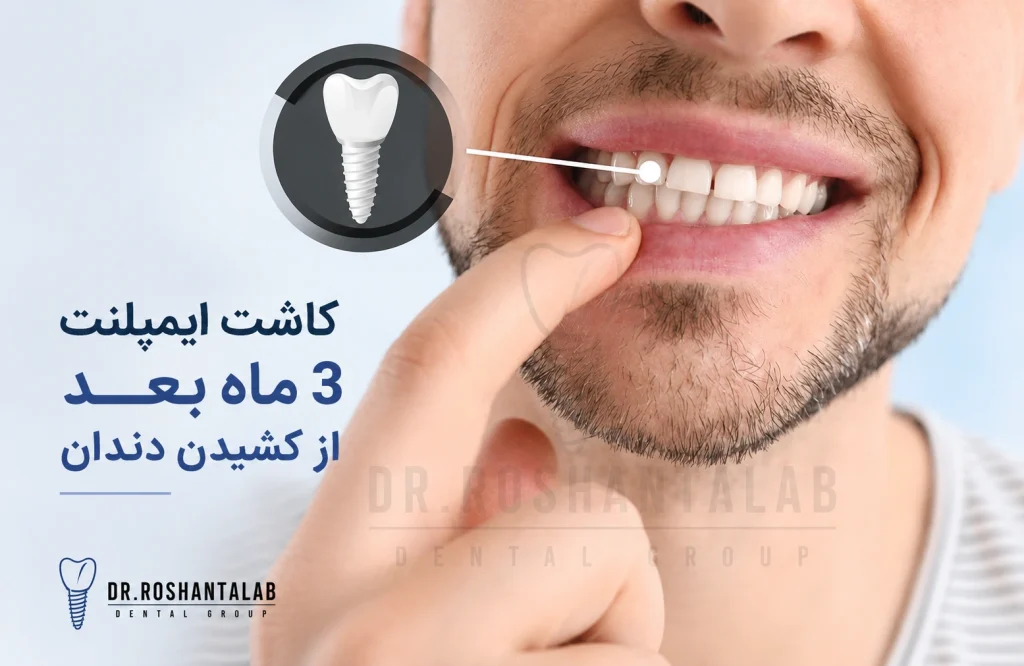 کاشت ایمپلنت 3 ماه بعد از کشیدن دندان